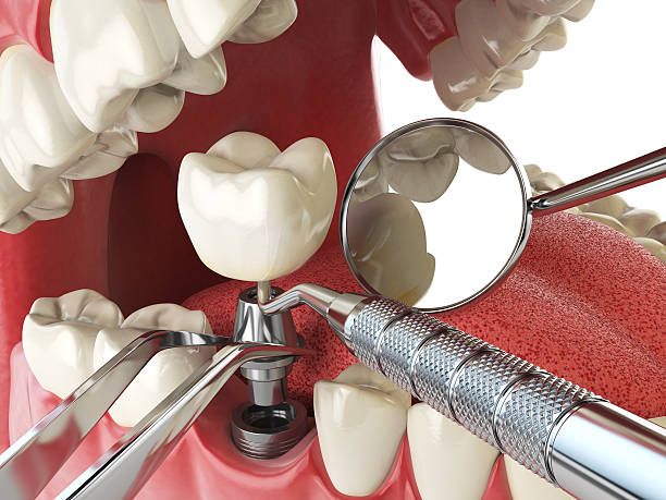 Best Knocked-Out Tooth (Avulsed Tooth) Treatment in Trappe, MD